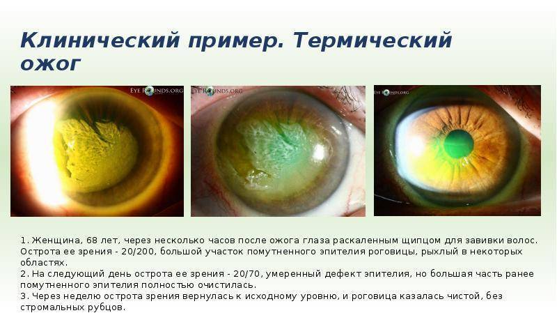 Ожог глаз кварцевой лампой: лечение, первая помощь, возможные последствия и осложнения
