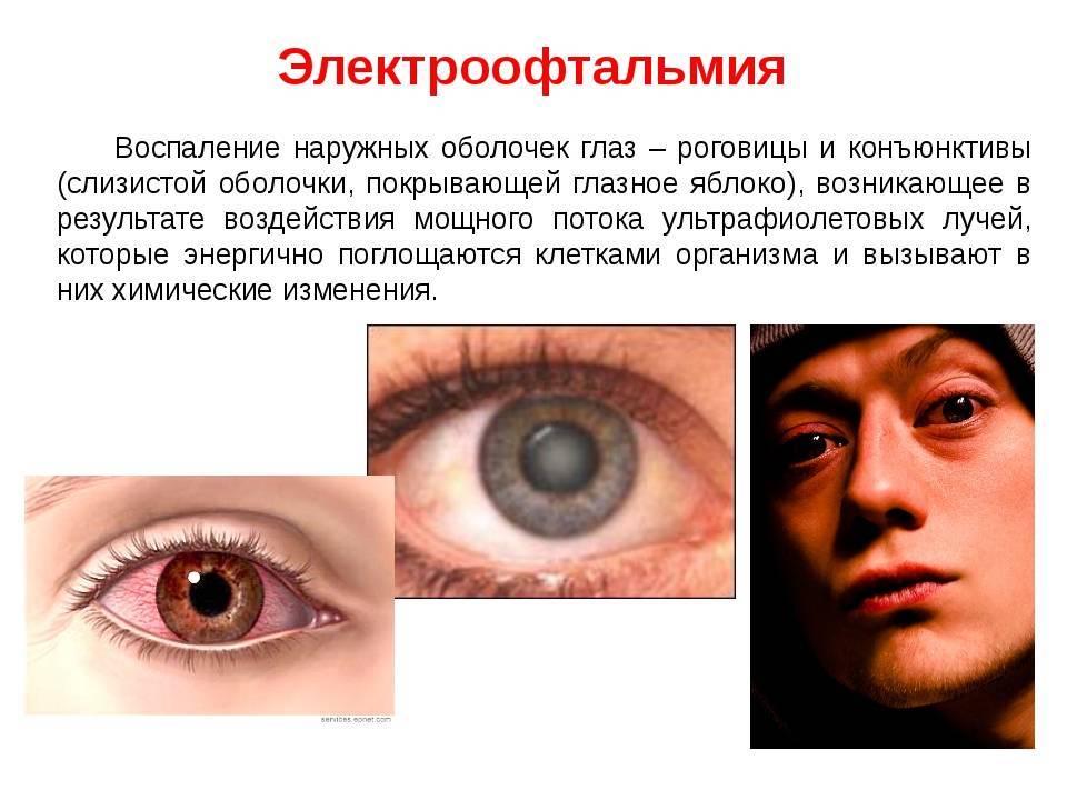 Ожог глаз ультрафиолетом: симптомы, лечение и первая помощь