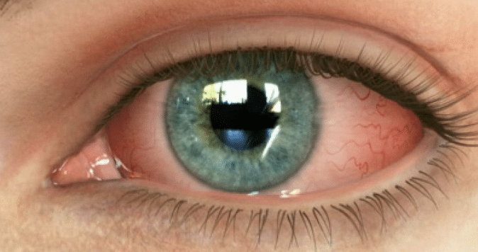 Ожог глаз кварцевой лампой: степень ожога, первая помощь, лечение